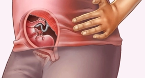 Adet Başlangıcında Kahverengi Akıntı